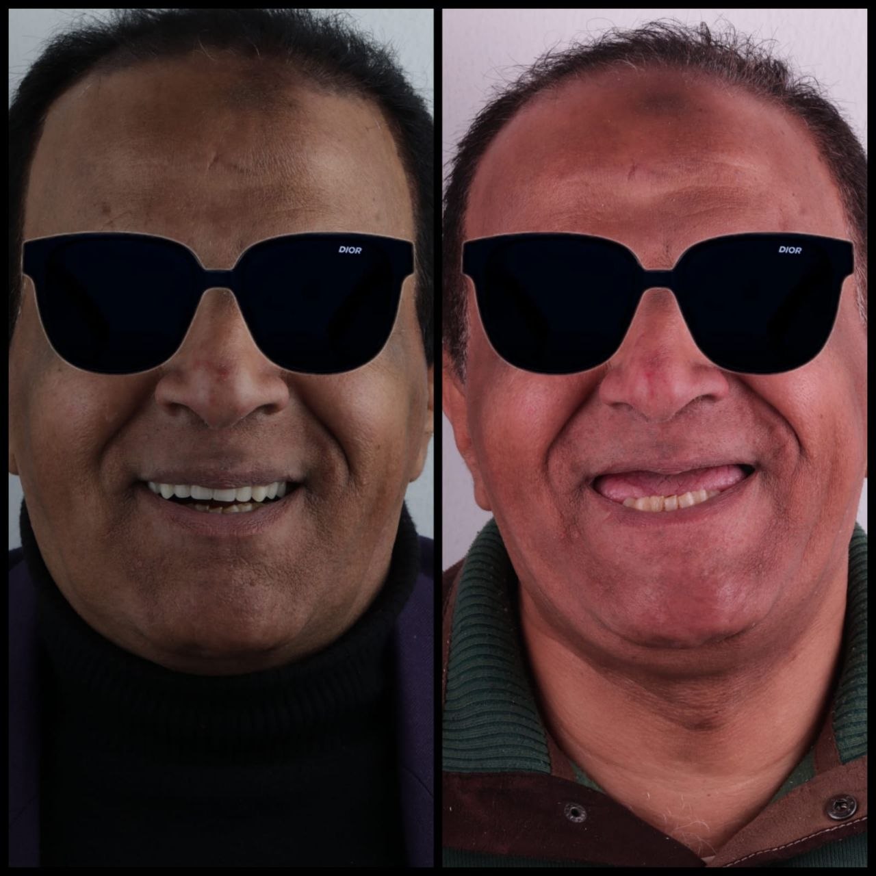 إعادة تأهيل الفك 3